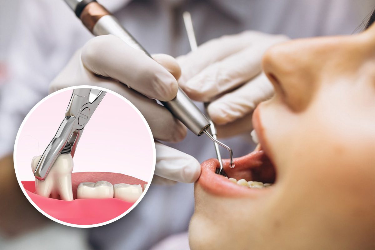 Removable Flexible Denture Dental Treatment in Ernakulam 